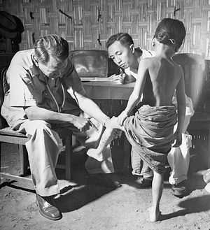 The team leader examines a girl for outward signs of yaws. Her leg bears the tell-tale ulcer.
Yaws (also known as frambesia tropica, thymosis, polypapilloma tropicum, parangi, bouba, frambösie and pian) is a tropical infection of the skin, bones and joints caused by the spirochete bacterium Treponema pallidum pertenue. The disease begins with a round, hard swelling of the skin, 2 to 5 centimeters in diameter. The center may break open and form an ulcer. This initial skin lesion typically heals after three to six months. After weeks to years, joints and bones may become painful, fatigue may develop, and new skin lesions may appear.The skin of the palms of the hands and the soles of the feet may become thick and break open. The bones (especially those of the nose) may become misshapen. After five years or more large areas of skin death with subsequent scarring may occur. 
Yaws is spread by direct contact with the fluid from a lesion of an infected person. The contact is usually of a non-sexual nature. The disease is most common among children, who spread it by playing together. Other related treponemal diseases are bejel (Treponema pallidum endemicum), pinta (Treponema pallidum carateum), and syphilis (Treponema pallidum pallidum). Yaws is often diagnosed by the appearance of the lesions. Blood antibody tests may be useful but cannot separate previous from current infections. Polymerase chain reaction (PCR) is the most accurate method of diagnosis. 
Prevention is, in part, by curing those who have the disease thereby decreasing the risk of transmission. Where the disease is common, treating the entire community is effective. Improving cleanliness and sanitation will also decrease spread. Treatment is typically with antibiotics including: azithromycin by mouth or benzathine penicillin by injection. Without treatment, physical deformities occur in 10% of cases. In the 1950s and 1960s the World Health Organization nearly eradicated yaws. Since then the number of cases has increased and there are renewed efforts to globally eradicate the disease by 2020.